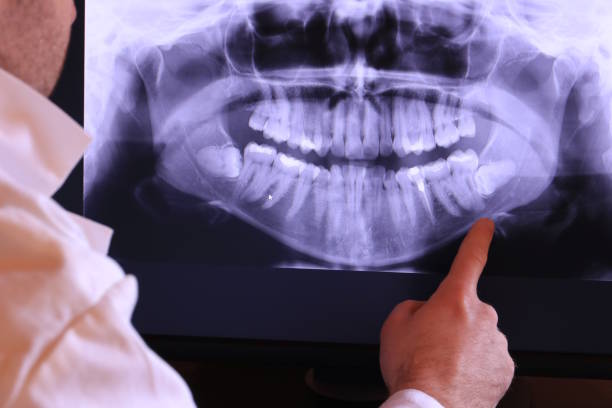 Best Emergency Wisdom Teeth Removal in Perry, UT